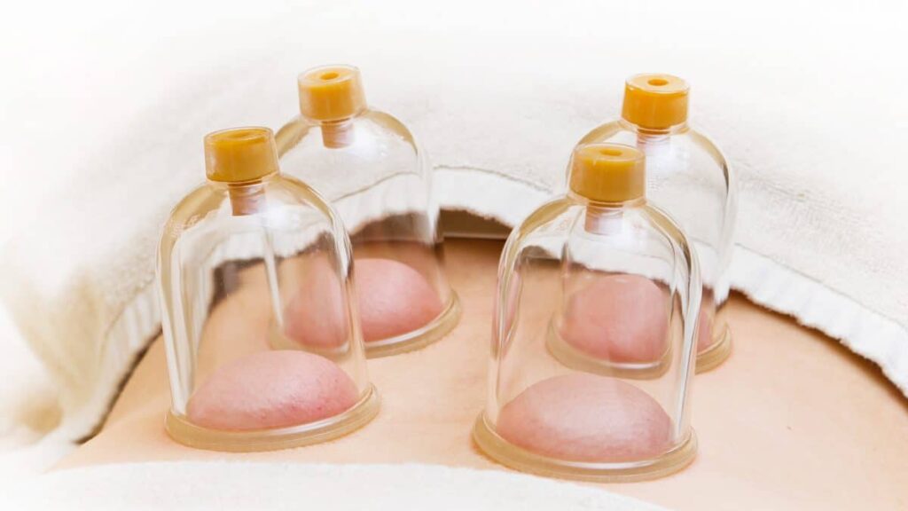 method of cupping